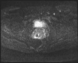 Adnexal multilocular cyst (O-RADS US 3- O-RADS MRI 3) (Radiopaedia 87426-103754 Axial DWI 49).jpg