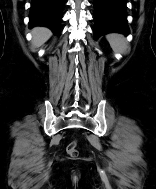 Adrenal cortical carcinoma (Radiopaedia 64017-72769 Coronal C+ delayed 50).jpg