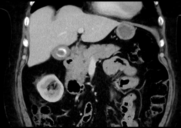 Adrenal cortical carcinoma (Radiopaedia 64017-72769 Coronal C+ portal venous phase 19).jpg