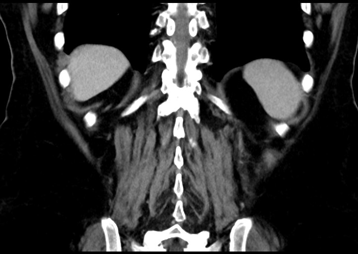Adrenal cortical carcinoma (Radiopaedia 64017-72769 Coronal C+ portal venous phase 44).jpg