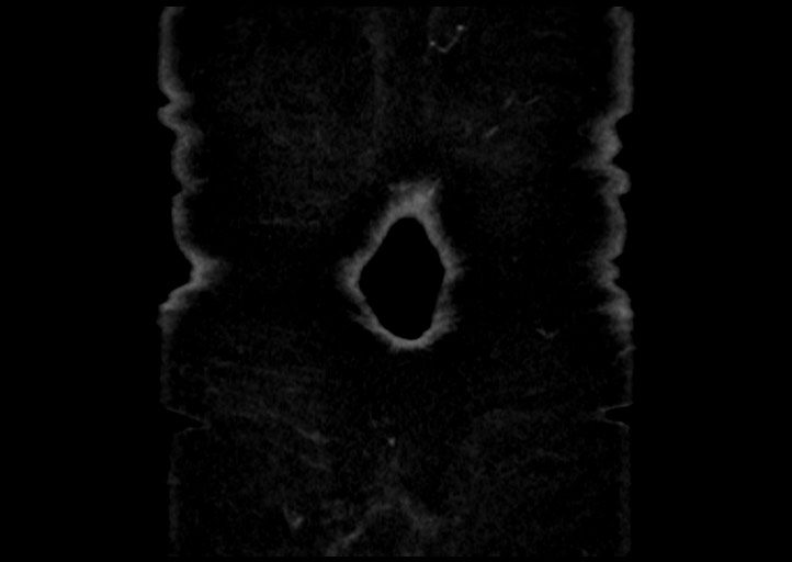 Adrenal cortical carcinoma (Radiopaedia 64017-72769 Coronal C+ portal venous phase 57).jpg