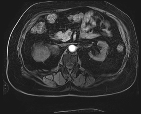 Adrenal cortical carcinoma (Radiopaedia 64017-72770 H 20).jpg