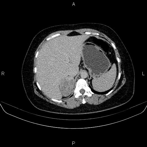 Adrenal cortical carcinoma (Radiopaedia 84882-100379 Axial C+ delayed 16).jpg