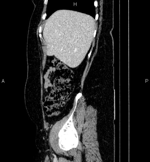Adrenal cortical carcinoma (Radiopaedia 84882-100379 Sagittal C+ portal venous phase 16).jpg