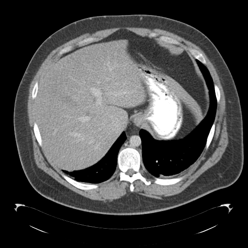 File:Adrenal cyst (Radiopaedia 45625-49776 Axial C+ portal venous phase 19).png