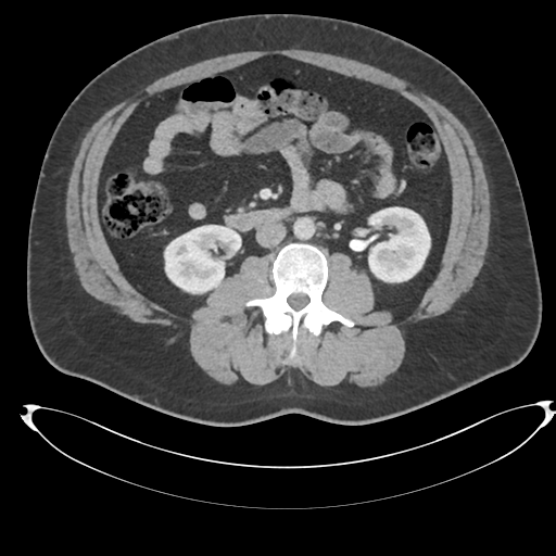 File:Adrenal cyst (Radiopaedia 45625-49778 AXIAL THICK 60 sec 48).png
