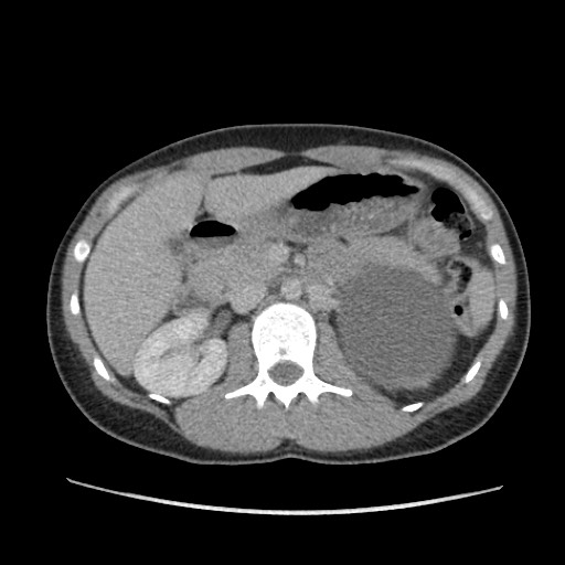 Adrenal cyst (Radiopaedia 64869-73813 Axial C+ portal venous phase 29).jpg