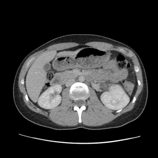 Adrenal cyst (Radiopaedia 64869-73813 Axial C+ portal venous phase 32).jpg