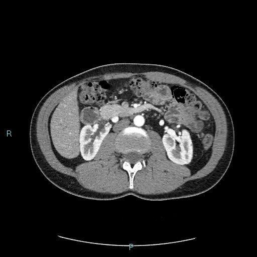 Adrenal cystic lymphangioma (Radiopaedia 83161-97534 Axial C+ arterial phase 42).jpg