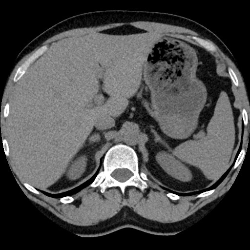 Adrenal gland trauma (Radiopaedia 81351-95079 Axial non-contrast 28).jpg