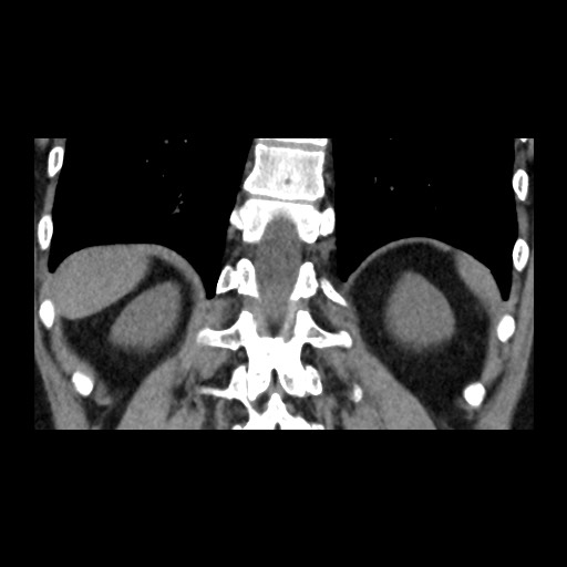 File:Adrenal gland trauma (Radiopaedia 81351-95079 Coronal non-contrast 70).jpg