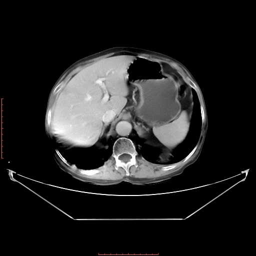 Adrenal hemangioma (Radiopaedia 68923-78668 Axial C+ portal venous phase 21).jpg