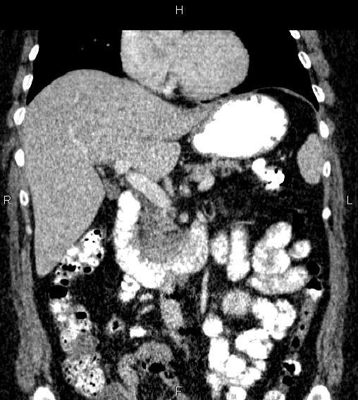 Adrenal myelolipoma (Radiopaedia 84319-99617 Coronal renal cortical phase 34).jpg