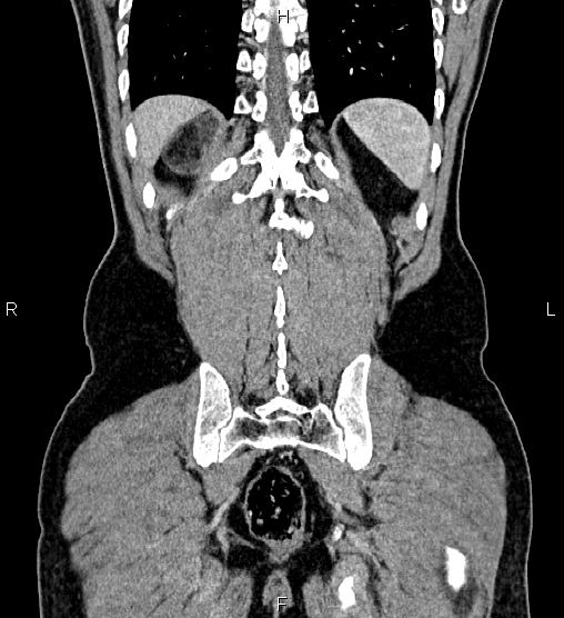 Adrenal myelolipoma (Radiopaedia 87794-104246 Coronal renal cortical phase 55).jpg