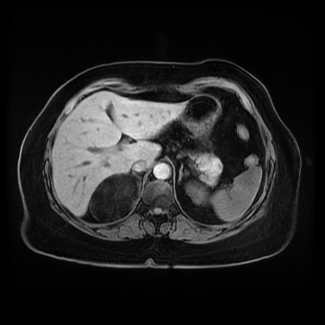 Adrenal myelolipoma - MRI (Radiopaedia 83249-97646 Axial T1 fat sat 21).jpg