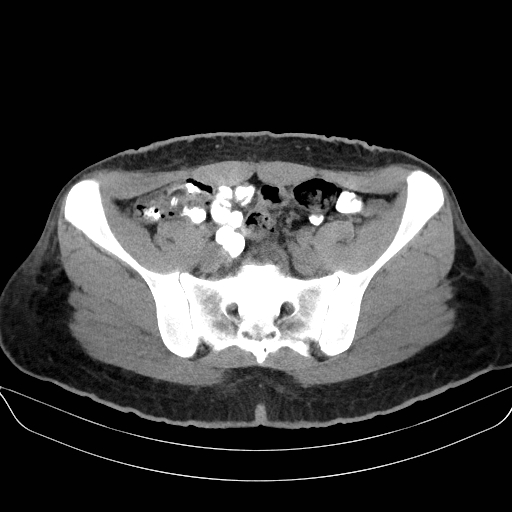 Adrenal myelolipoma - bilateral (Radiopaedia 74805-85810 Axial non-contrast 62).jpg