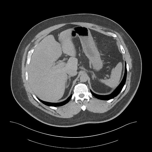 File:Adrenal vein sampling and adrenal nodular hyperplasia - Conn syndrome (Radiopaedia 30561-31337 Axial non-contrast 17).jpg