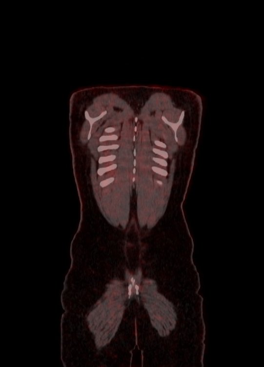 Adrenocortical carcinoma (Radiopaedia 80134-93440 Coronal 175).jpg