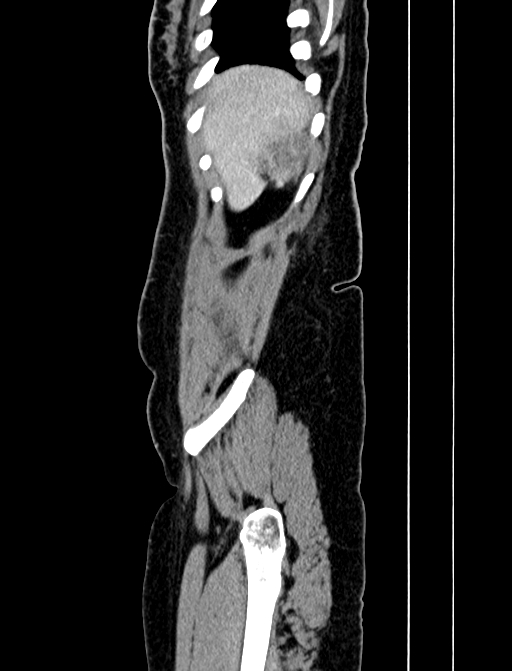 Adrenocortical carcinoma (Radiopaedia 87281-103569 Sagittal C+ portal venous phase 11).jpg