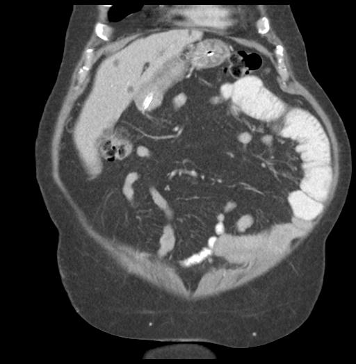 Adult ileal intussusception with secondary obstruction (Radiopaedia 30395-31051 Coronal C+ portal venous phase 22).jpg