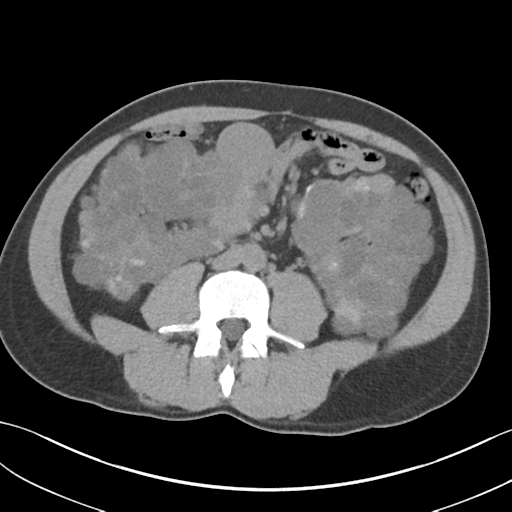 File:Adult polycystic kidney disease (Radiopaedia 47866-52626 Axial non-contrast 45).png