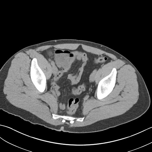 File:Adult polycystic kidney disease (Radiopaedia 47866-52626 Axial non-contrast 72).png