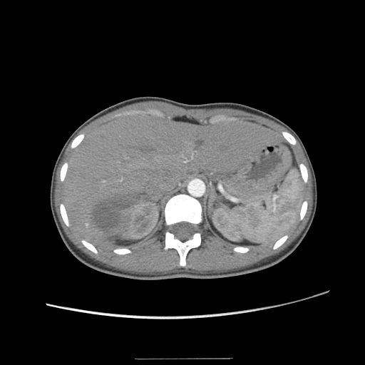Adult polycystic kidney disease (Radiopaedia 48845-53876 Axial renal cortical phase 8).jpg