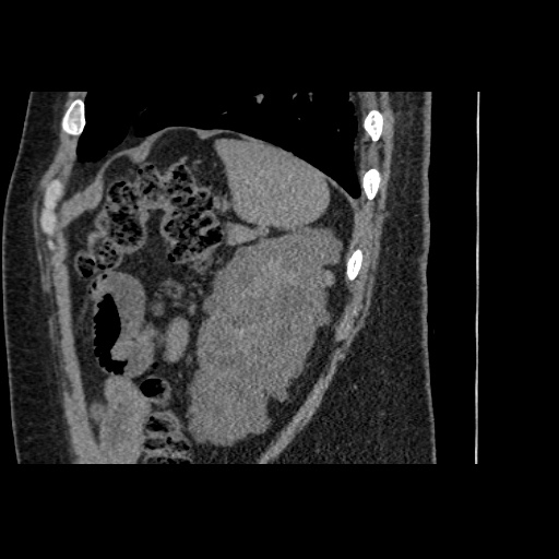 Adult polycystic kidney disease (Radiopaedia 59075-66368 Sagittal non-contrast 76).jpg