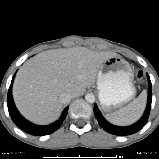 File:Agenesis of the gallbladder (Radiopaedia 55454-61905 B 15).jpg