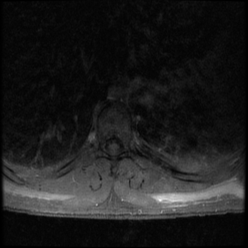 File:Aggressive vertebral hemangioma (Radiopaedia 39937-42404 Axial T1 C+ fat sat 16).png