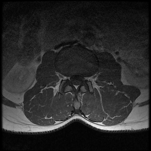 File:Aggressive vertebral hemangioma with pathological fracture (Radiopaedia 69528-79411 Axial T1 C+ 7).jpg