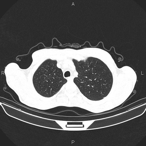 Air bronchogram in pneumonia (Radiopaedia 85719-101512 Axial lung window 14).jpg