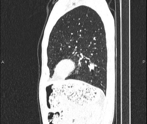File:Air bronchogram in pneumonia (Radiopaedia 85719-101512 Sagittal lung window 73).jpg