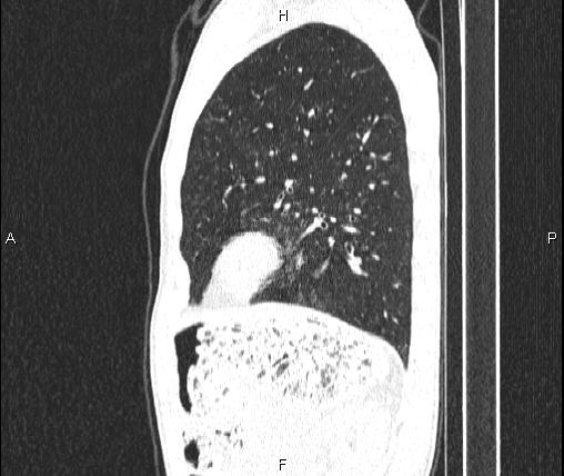 Air bronchogram in pneumonia (Radiopaedia 85719-101512 Sagittal lung window 74).jpg
