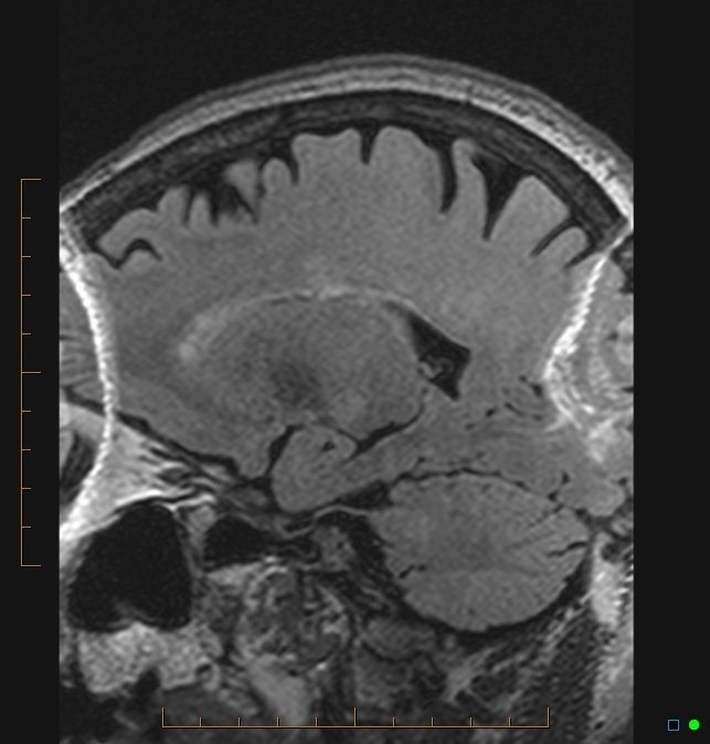 Aliasing artifact causing a spurious cerebellar lesion (Radiopaedia 48783-53810 Sagittal FLAIR 14).jpg