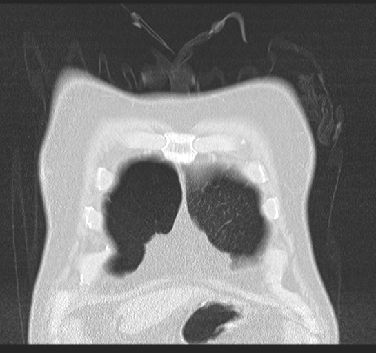 Allergic bronchopulmonary aspergillosis (Radiopaedia 44760-48571 Coronal lung window 10).png