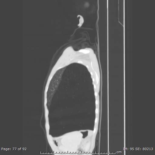 File:Alpha-1-antitrypsin deficiency (Radiopaedia 50561-55987 Sagittal lung window 37).jpg