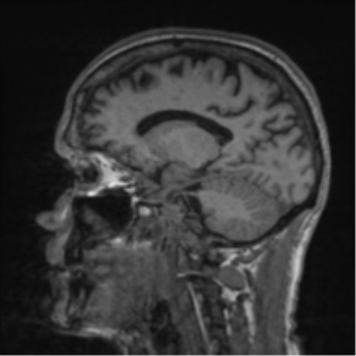 File:Alzheimer's disease- with apraxia (Radiopaedia 54763-61011 Sagittal T1 27).png