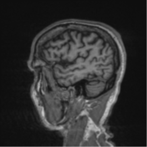 File:Alzheimer's disease- with apraxia (Radiopaedia 54763-61011 Sagittal T1 58).png