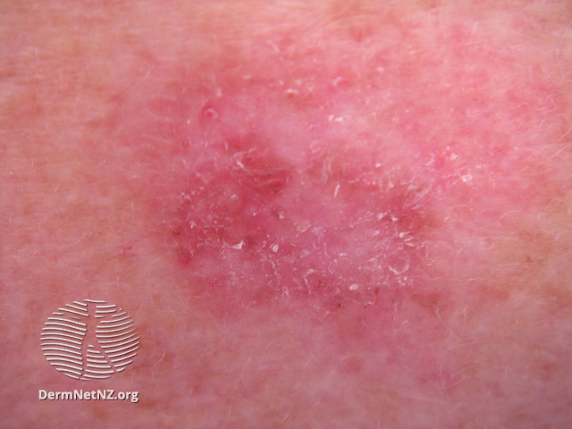 File:Amelanotic melanoma (DermNet NZ amelanotic-melanoma-016).jpg
