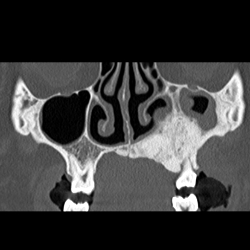 File:Ameloblastic fibro-odontoma (Radiopaedia 18843-18780 B 12).jpg