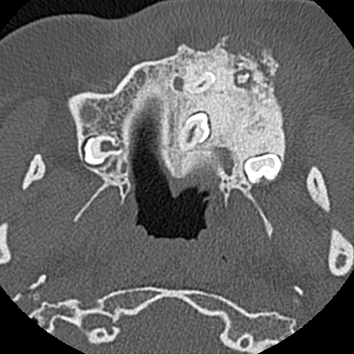 Ameloblastic fibro-odontoma (Radiopaedia 18843-18780 C 34).jpg