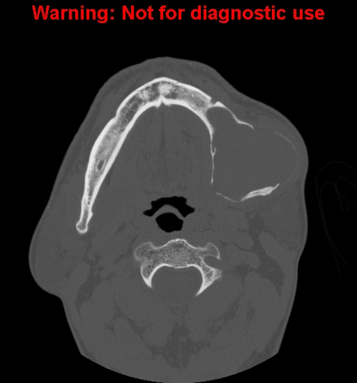File:Ameloblastoma (Radiopaedia 13276-13280 Axial non-contrast 9).jpg