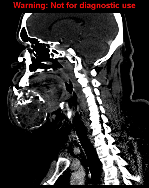 Ameloblastoma (Radiopaedia 33126-34164 F 41).jpg
