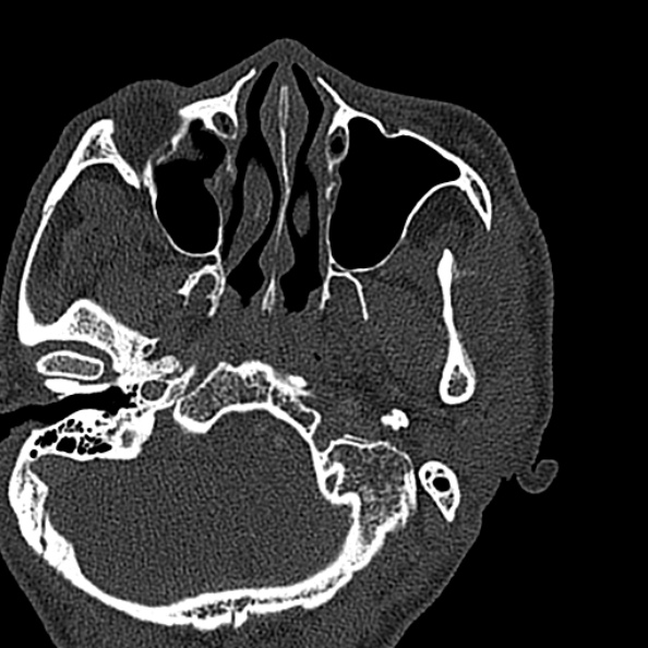 Ameloblastoma (Radiopaedia 51921-57766 Axial bone window 140).jpg