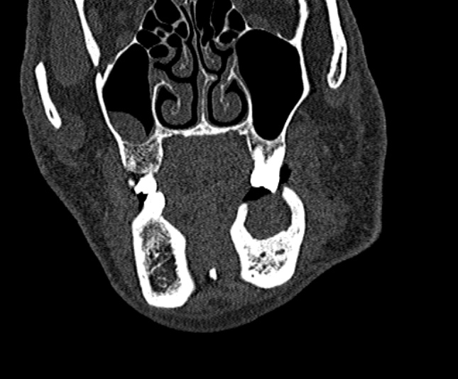 Ameloblastoma (Radiopaedia 51921-57766 Coronal bone window 70).jpg