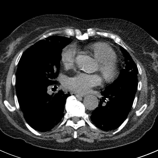 File:Amiodarone-induced pulmonary fibrosis (Radiopaedia 82355-96460 Axial non-contrast 36).jpg