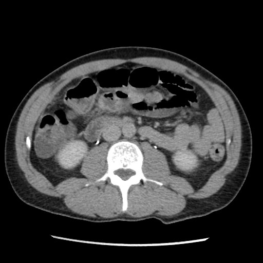 Amoebic liver abscesses (Radiopaedia 55536-62009 Axial C+ delayed 46).jpg