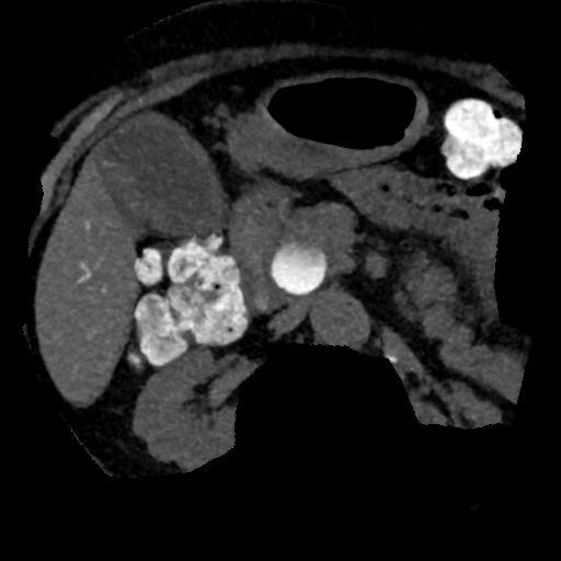 Ampullary adenocarcinoma (Radiopaedia 34013-35241 AXIAL MIPS 3-1.5 62).png