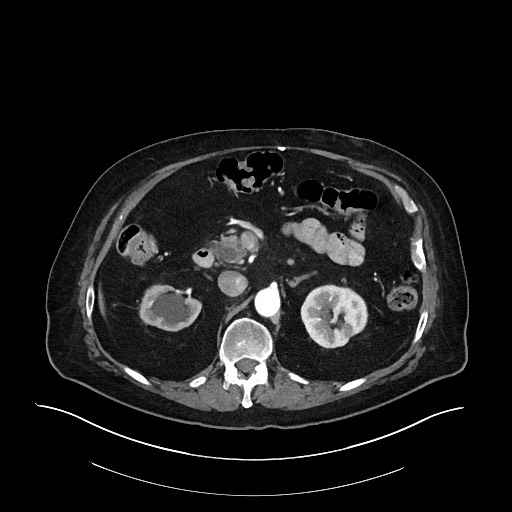 Ampullary adenocarcinoma (Radiopaedia 59373-66734 A 62).jpg